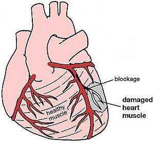 Symptoms of Heart Attack in Men & Women