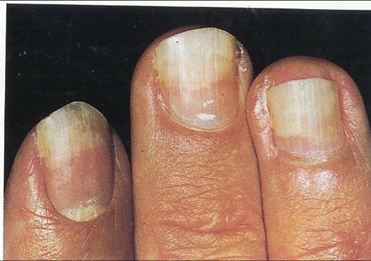 Ridges On Fingernails Deficiency. Crumbling away of fingernails: